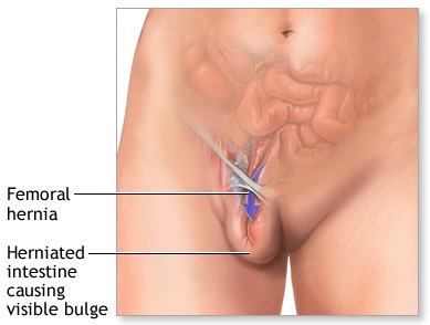 Detail Gambar Hernia Wanita Nomer 8