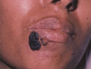 Detail Gambar Herpes Simpleks Nomer 24