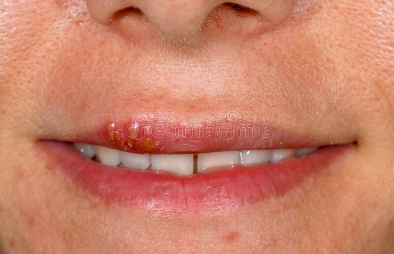 Detail Gambar Herpes Simpleks Nomer 27