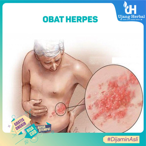 Detail Gambar Herpes Simpleks Nomer 28