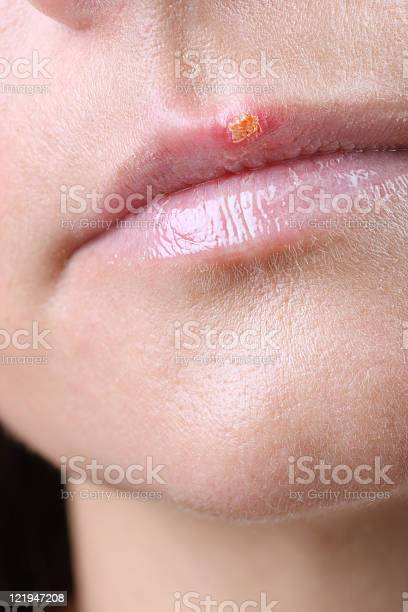 Detail Gambar Herpes Simpleks Nomer 37