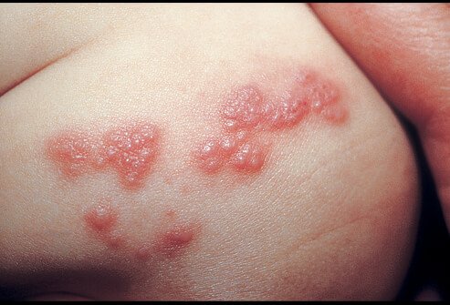 Gambar Herpes Zoster - KibrisPDR