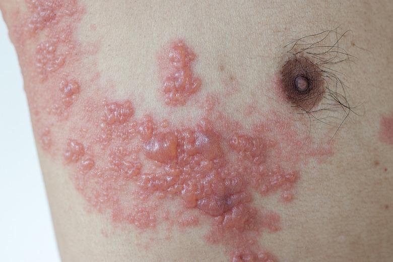 Detail Gambar Herpes Zoster Nomer 14