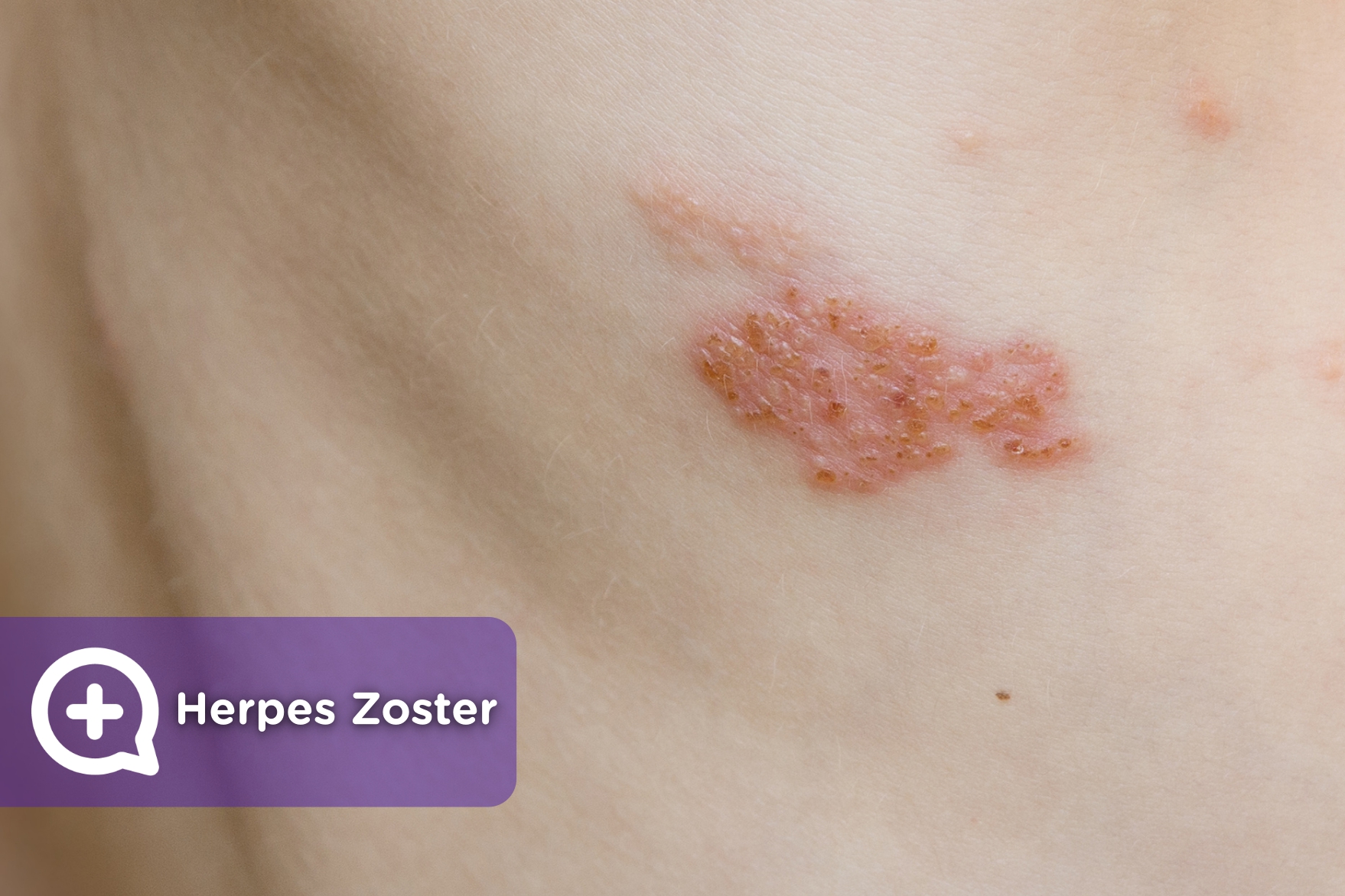 Detail Gambar Herpes Zoster Nomer 25