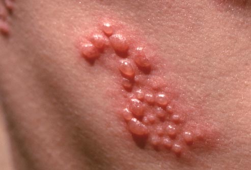 Detail Gambar Herpes Zoster Nomer 26