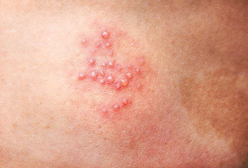 Detail Gambar Herpes Zoster Nomer 28