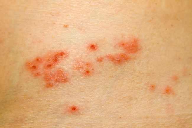 Detail Gambar Herpes Zoster Nomer 43