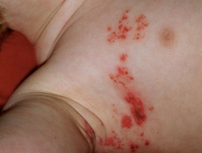 Detail Gambar Herpes Zoster Nomer 54