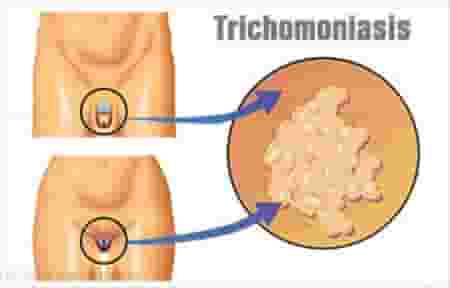 Detail Contoh Gambar Penyakit Klamidia Nomer 4