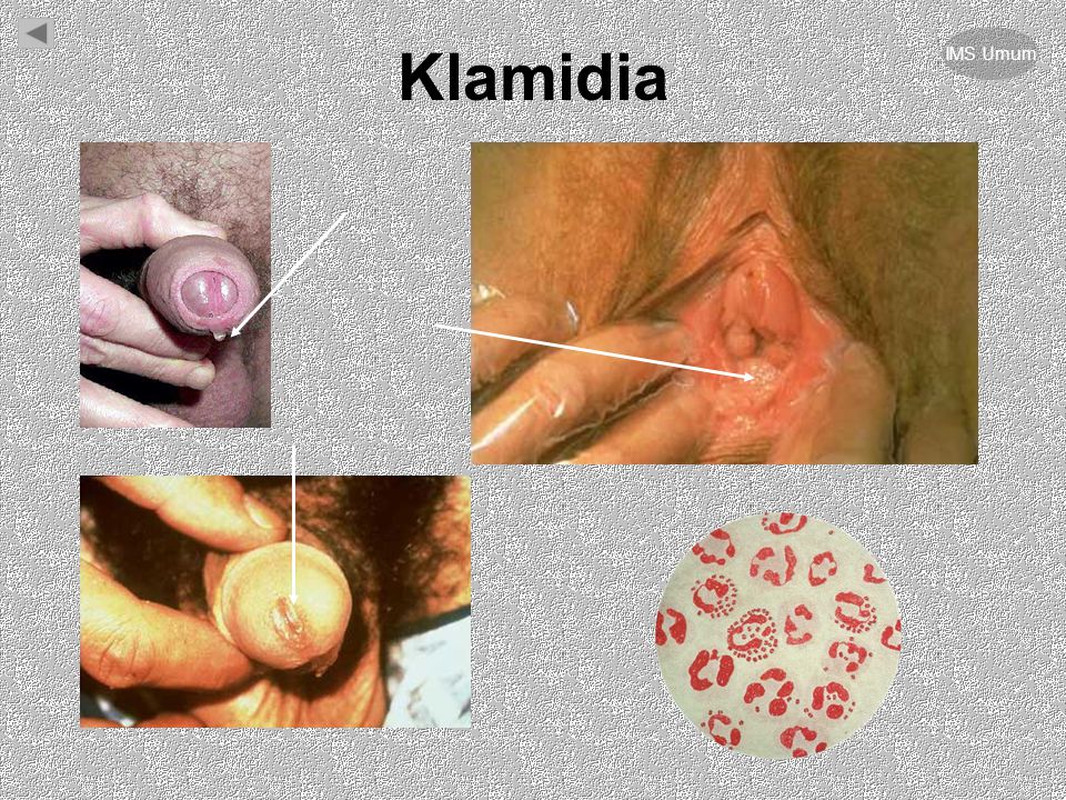 Detail Contoh Gambar Penyakit Klamidia Nomer 5