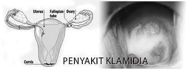 Detail Contoh Gambar Penyakit Klamidia Nomer 37