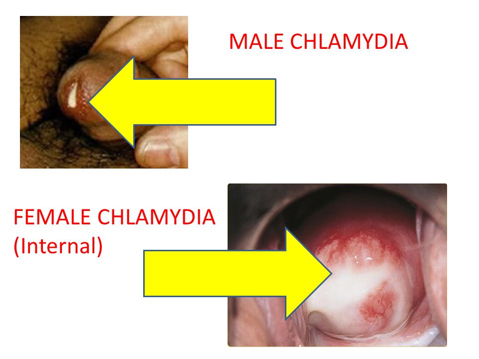 Detail Contoh Gambar Penyakit Klamidia Nomer 10