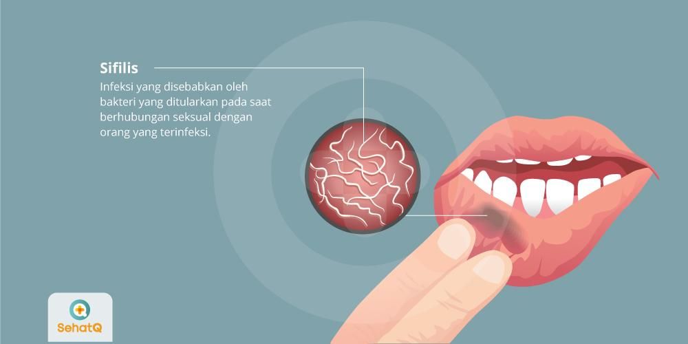 Detail Contoh Gambar Penyakit Sipilis Nomer 2