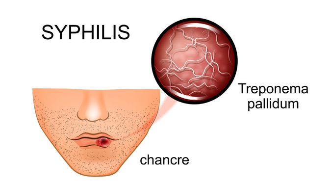 Detail Contoh Gambar Penyakit Sipilis Nomer 4