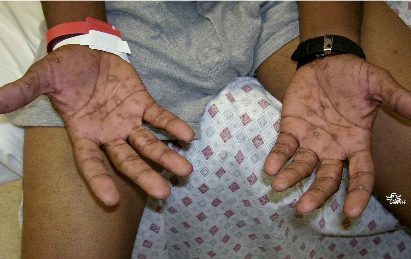 Detail Contoh Gambar Penyakit Sipilis Nomer 37