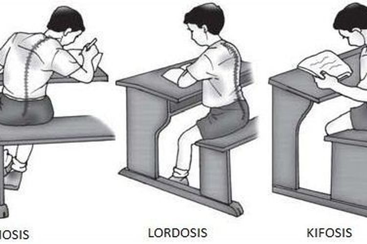 Detail Contoh Gambar Skoliosis Nomer 2