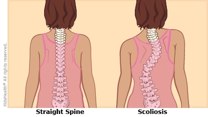 Detail Contoh Gambar Skoliosis Nomer 12