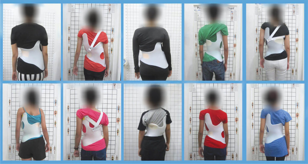 Detail Contoh Gambar Skoliosis Nomer 13