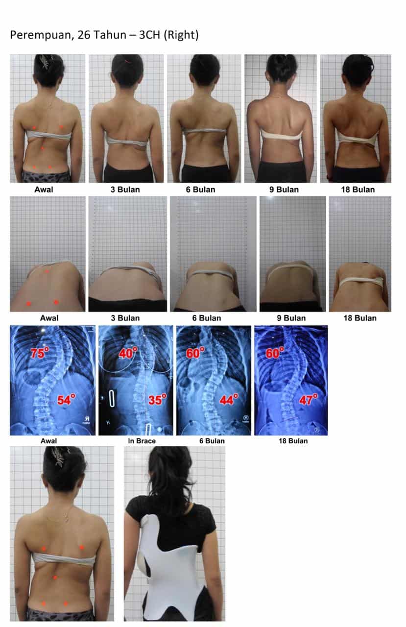 Detail Contoh Gambar Skoliosis Nomer 14