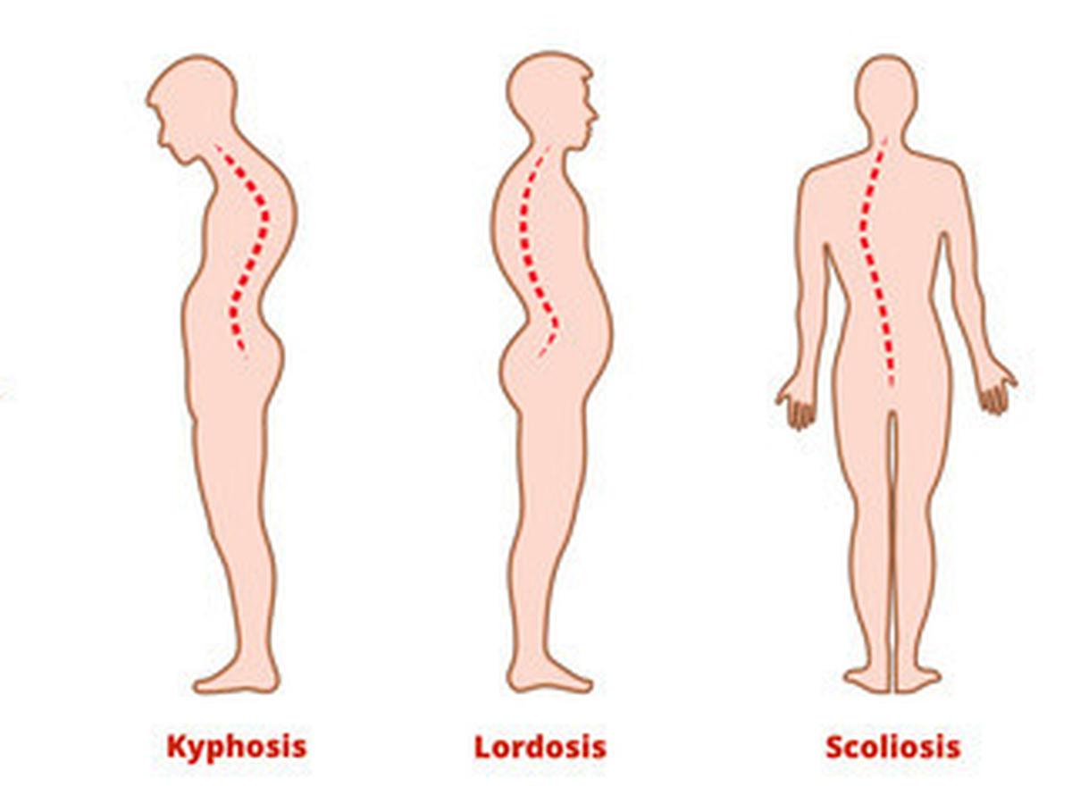 Detail Contoh Gambar Skoliosis Nomer 3