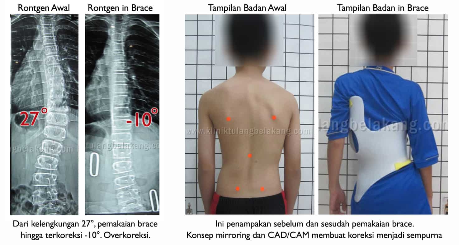 Detail Contoh Gambar Skoliosis Nomer 20