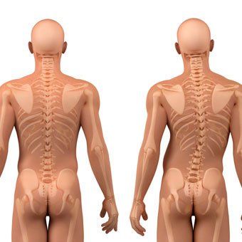 Detail Contoh Gambar Skoliosis Nomer 23