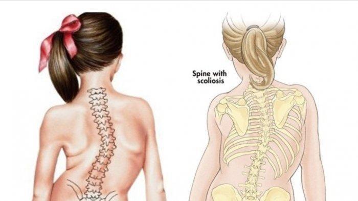 Detail Contoh Gambar Skoliosis Nomer 24