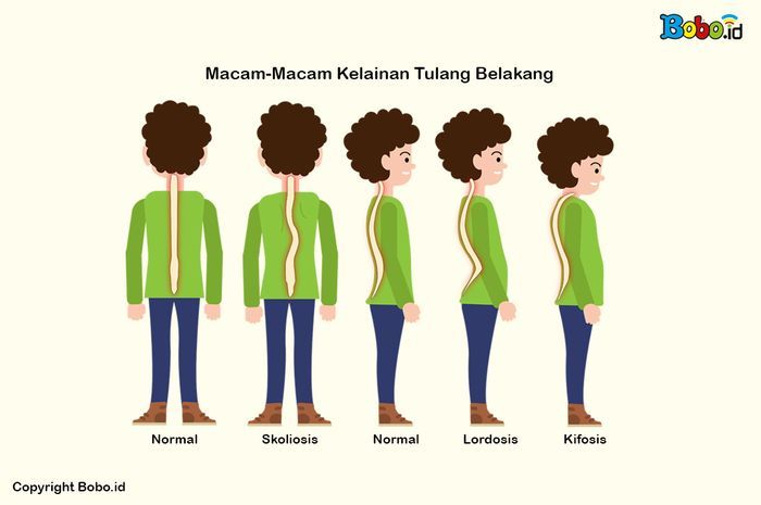 Detail Contoh Gambar Skoliosis Nomer 4