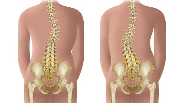 Detail Contoh Gambar Skoliosis Nomer 31