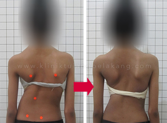 Detail Contoh Gambar Skoliosis Nomer 32