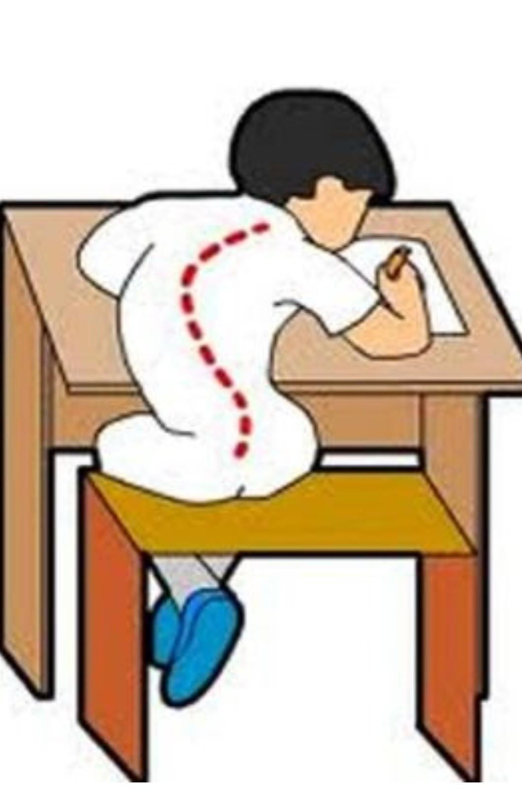 Detail Contoh Gambar Skoliosis Nomer 33