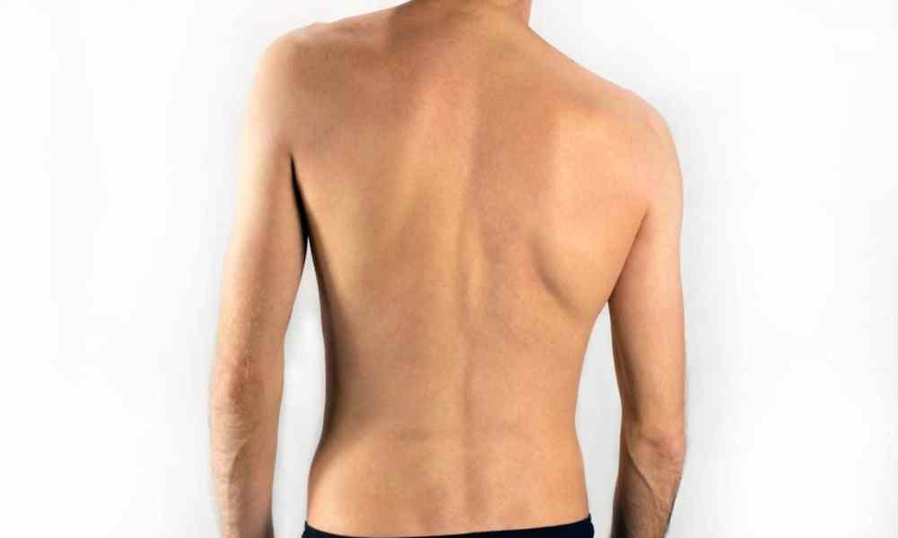 Detail Contoh Gambar Skoliosis Nomer 34