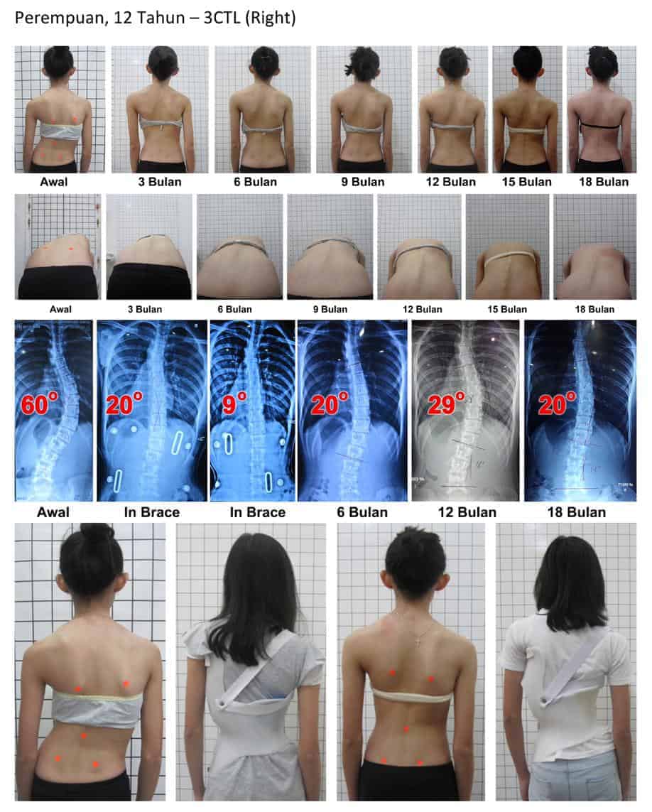 Detail Contoh Gambar Skoliosis Nomer 35