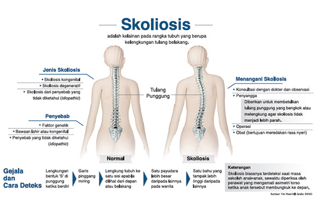 Detail Contoh Gambar Skoliosis Nomer 5
