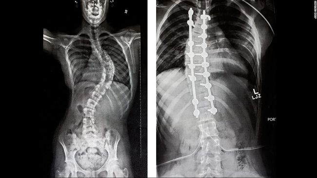 Detail Contoh Gambar Skoliosis Nomer 37