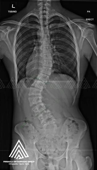 Detail Contoh Gambar Skoliosis Nomer 38