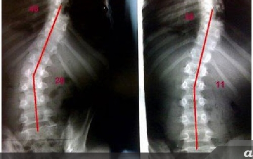 Detail Contoh Gambar Skoliosis Nomer 40