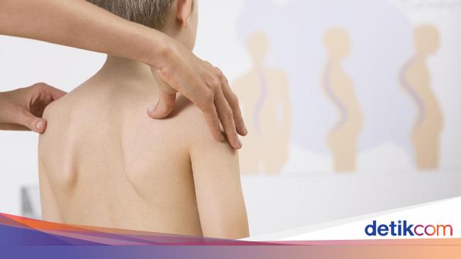 Detail Contoh Gambar Skoliosis Nomer 41