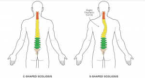 Detail Contoh Gambar Skoliosis Nomer 44