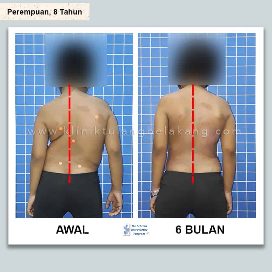 Detail Contoh Gambar Skoliosis Nomer 6