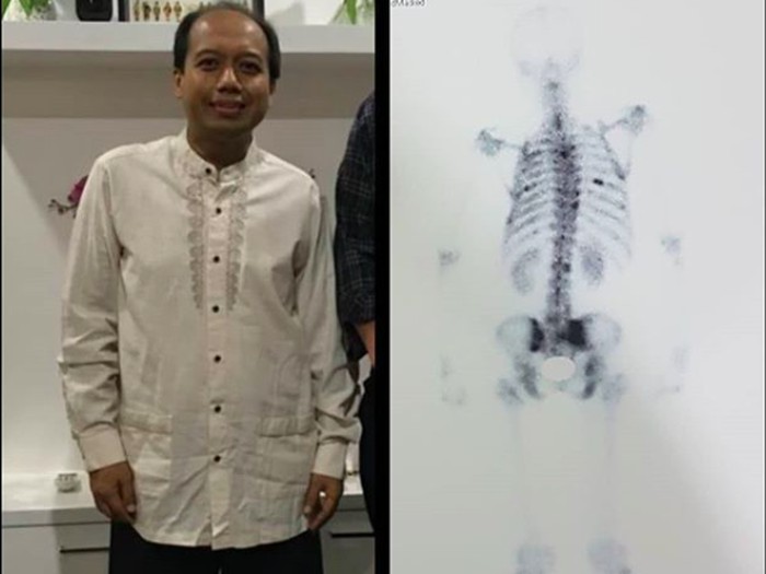 Detail Contoh Gambar Skoliosis Nomer 48