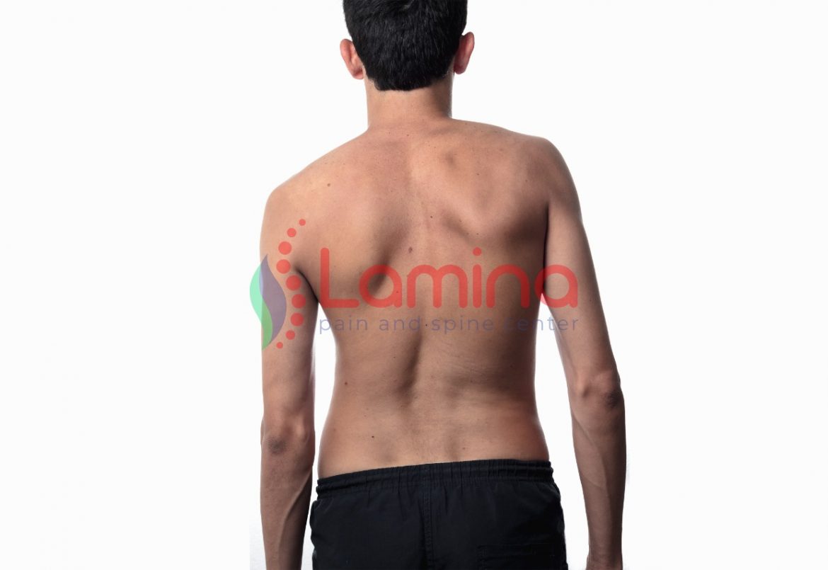 Detail Contoh Gambar Skoliosis Nomer 50