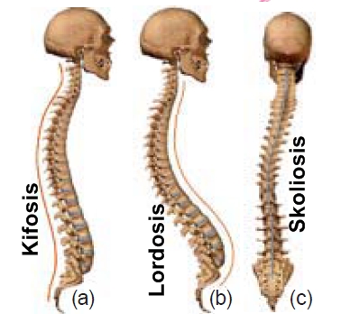 Detail Contoh Gambar Skoliosis Nomer 10