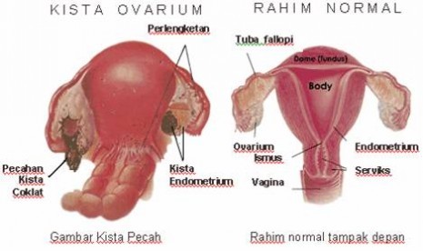 Detail Contoh Gambar Usg Kista Nomer 31