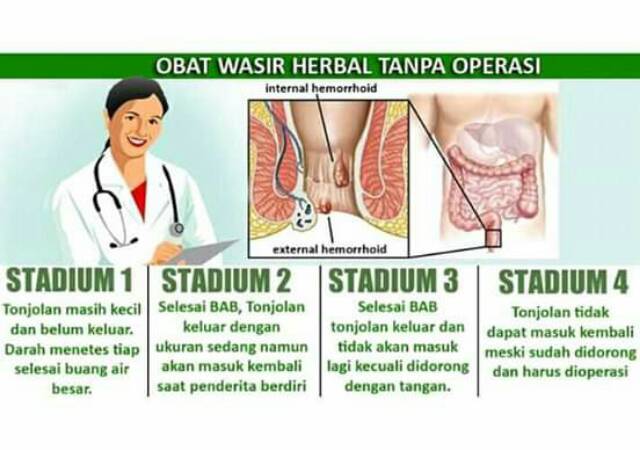 Detail Contoh Gambar Wasir Stadium 4 Nomer 11