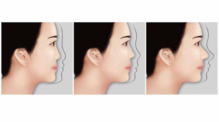 Detail Gambar Hidung Pesek Nomer 32