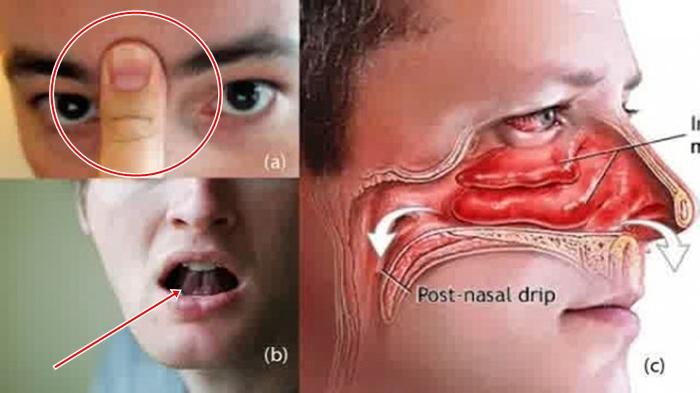 Detail Gambar Hidung Tersumbat Nomer 6