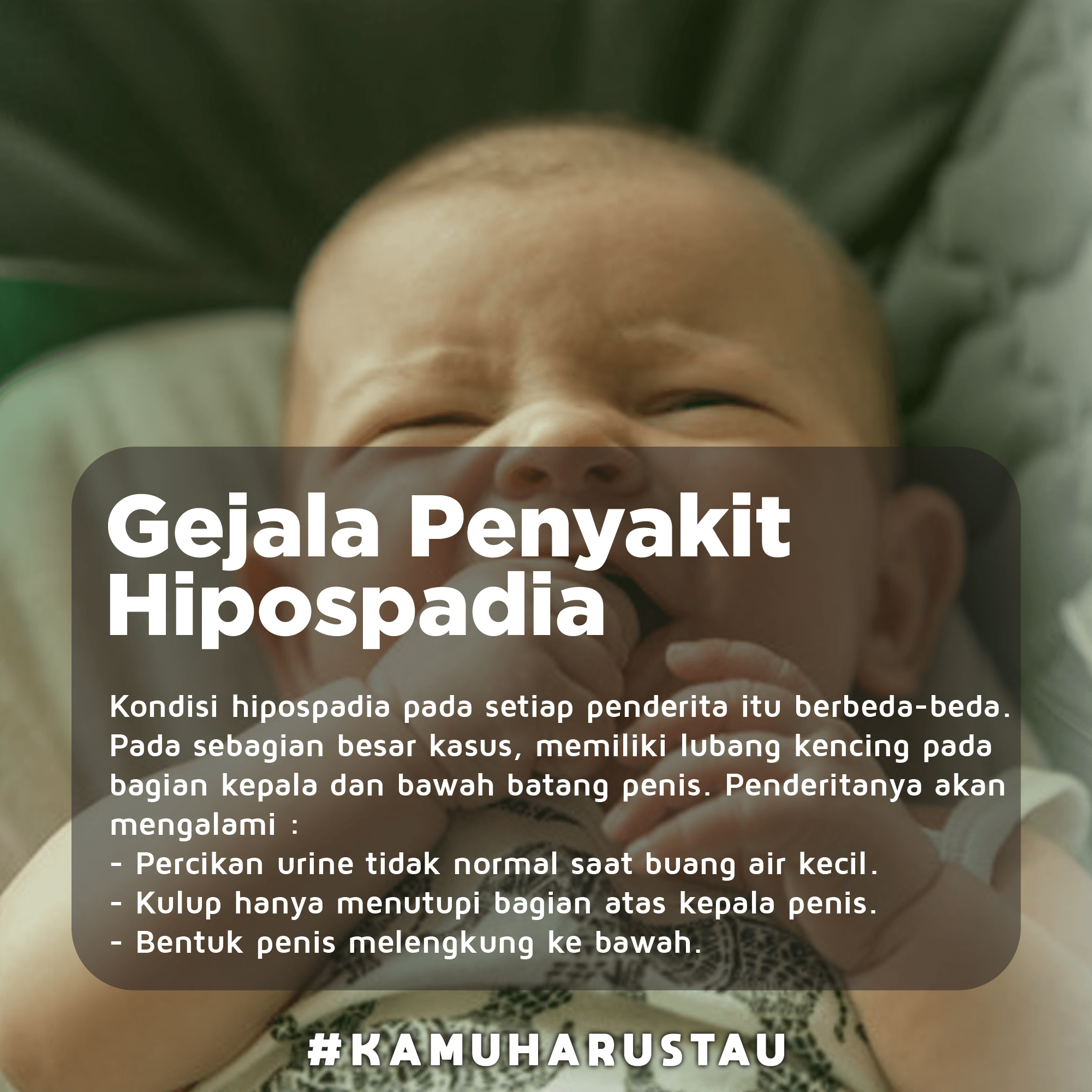 Detail Gambar Hipospadia Pada Bayi Nomer 31