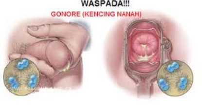 Detail Gambar Ilustrasi Penyakit Gonore Nomer 17