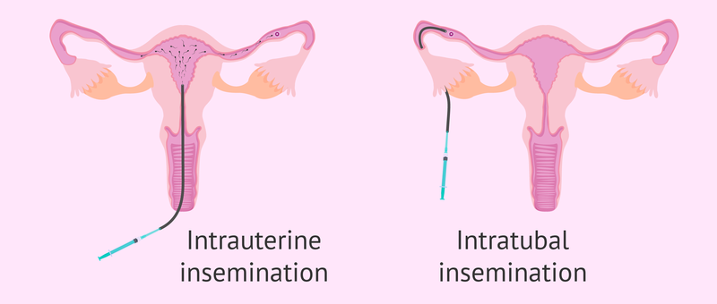 Detail Contoh Inseminasi Buatan Nomer 10